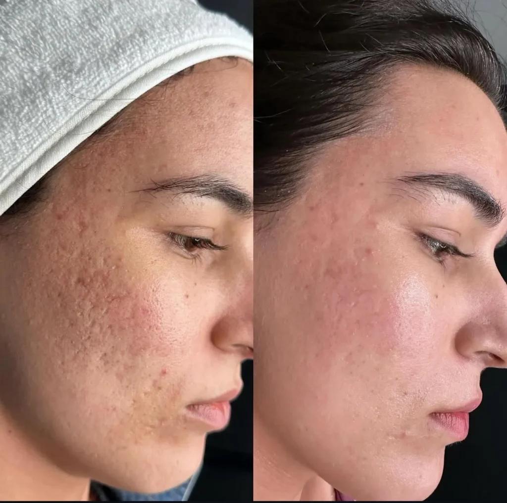 Before and after acne scar revision result