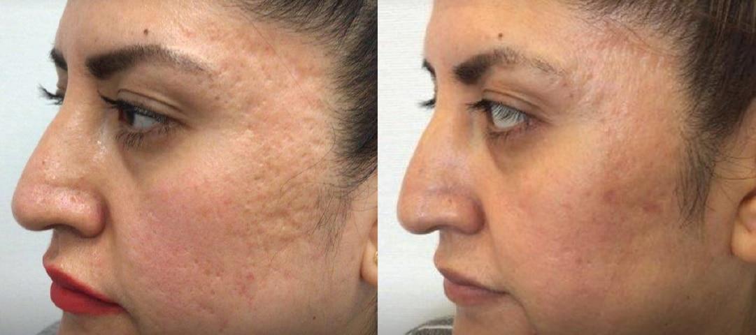 Before and after acne scar texture result