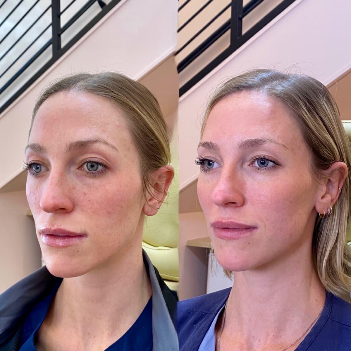 Before and after facial balance and volume result