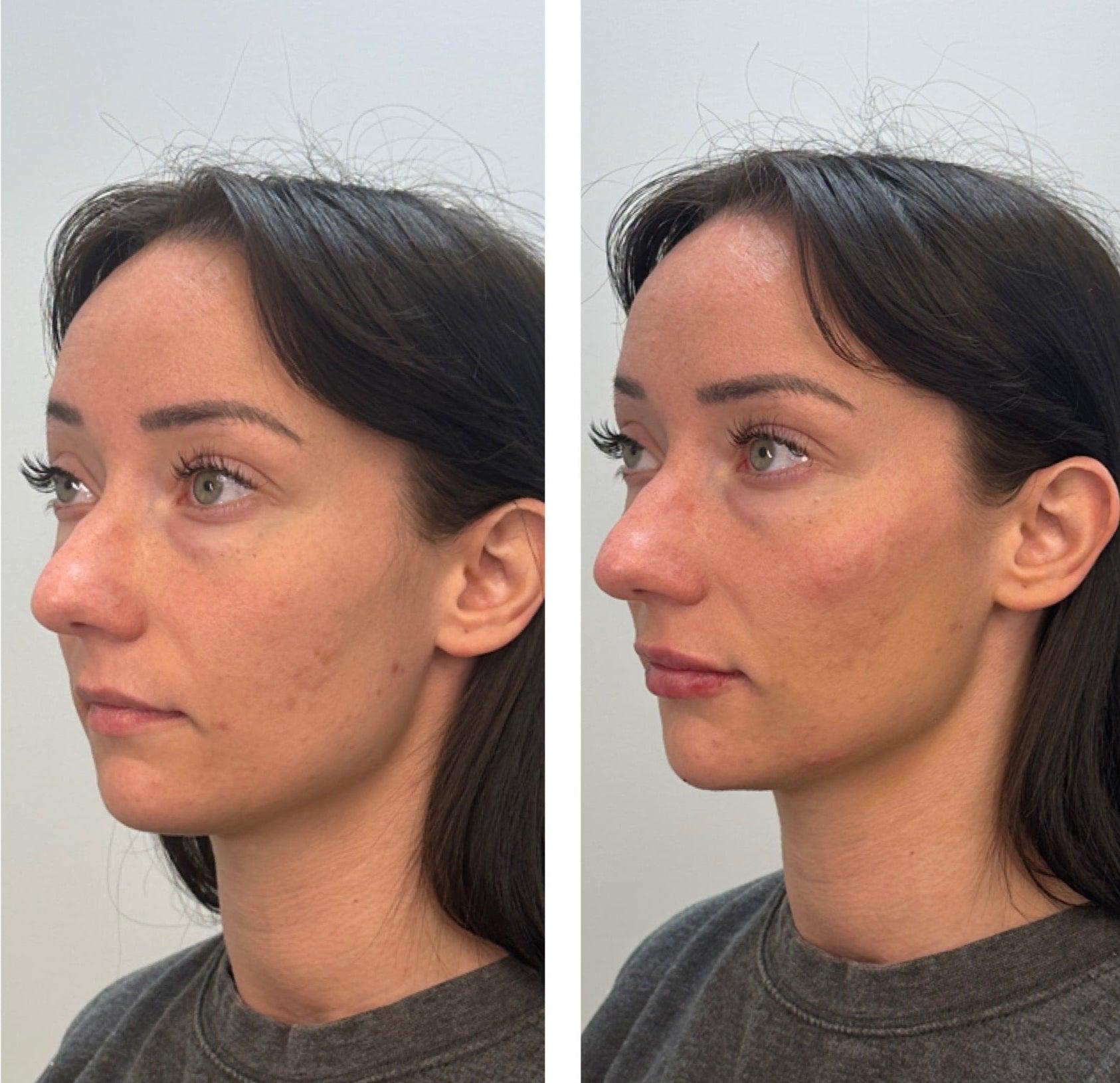 Before and after facial contour and volume result