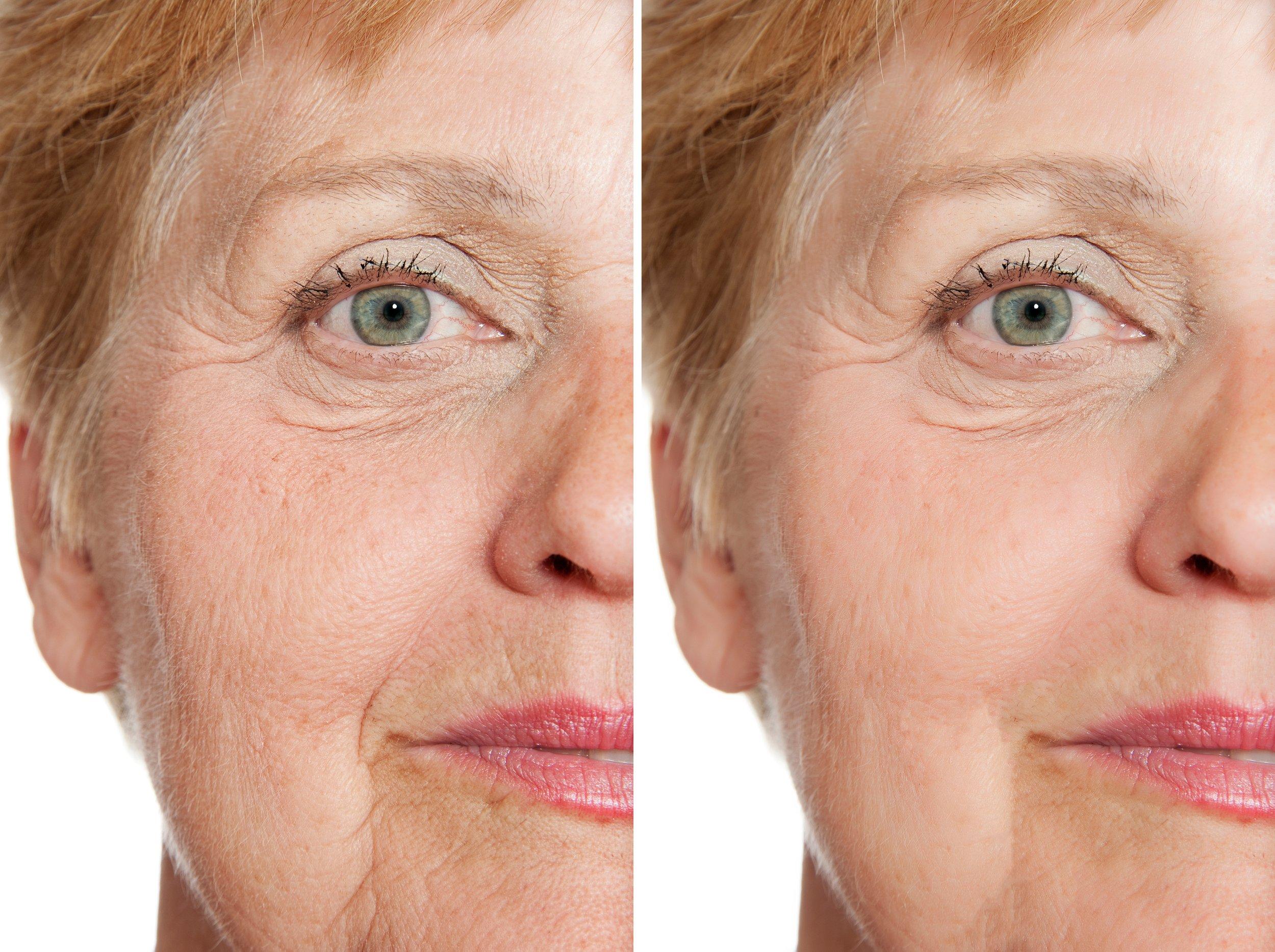 Before and after fine lines and wrinkles result around the eye area