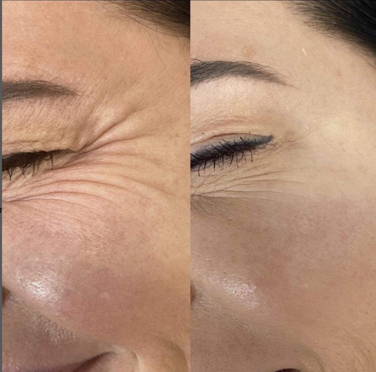 Before and after eye-area wrinkle result