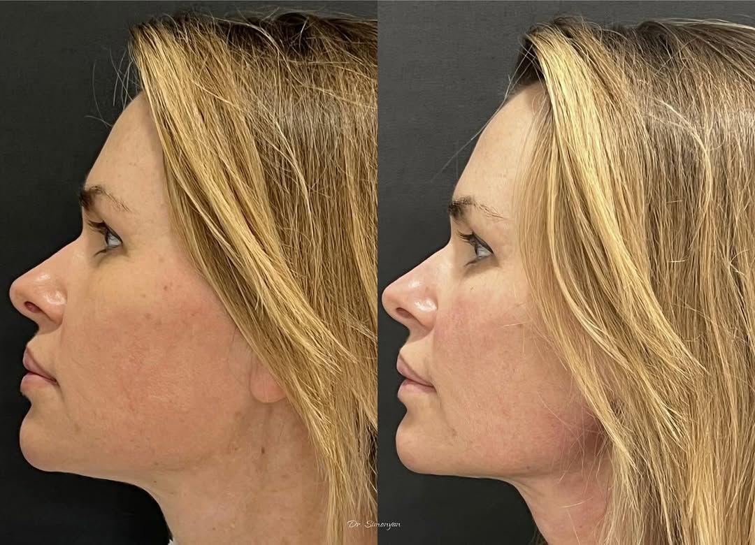 Before and after lifting and contouring profile result