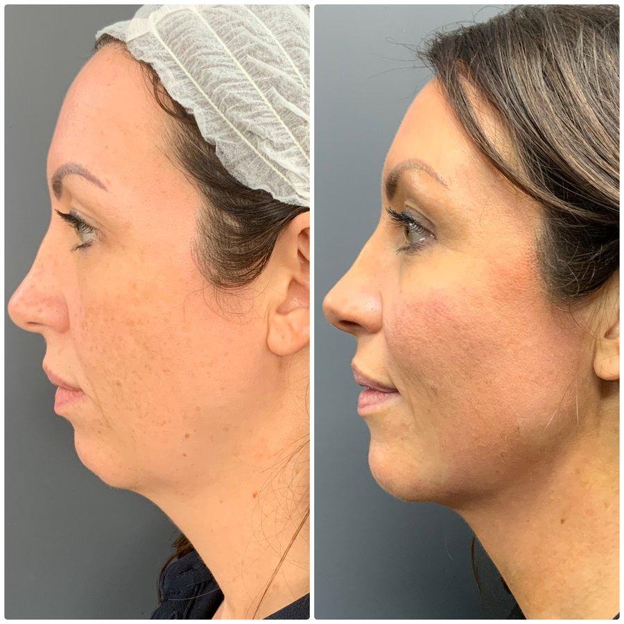 Before and after lifting and contouring jawline result