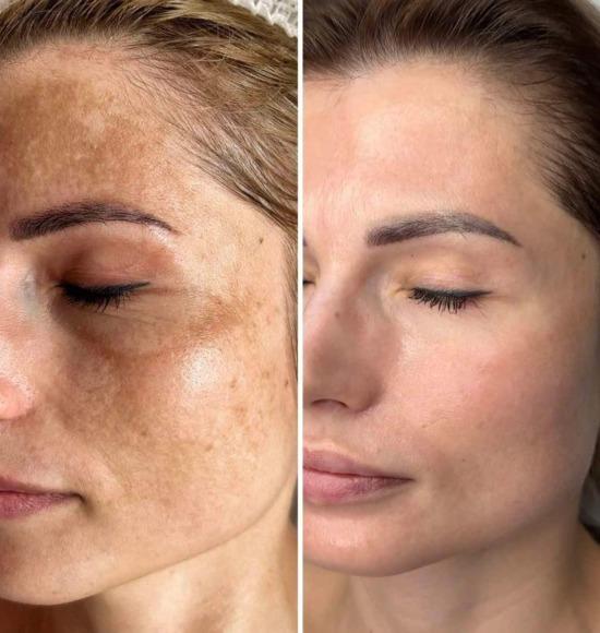 Before and after pigmentation and uneven tone result