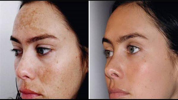 Before and after pigmentation and uneven tone result