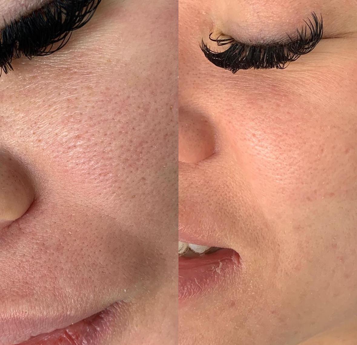 Before and after pore and skin texture result